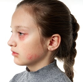 girl_bad_face_skin girl bad face skin