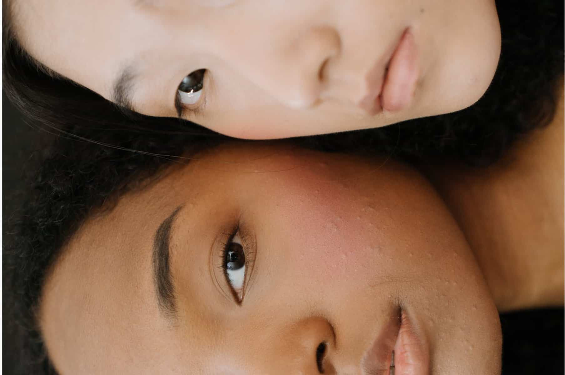 The 10 Best Organic Acne Treatments