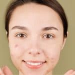 What does acne look like